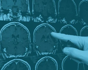 Trivent Neurologist Identifies Deviations from Standard of Care in Cerebral Venous Thrombosis Case