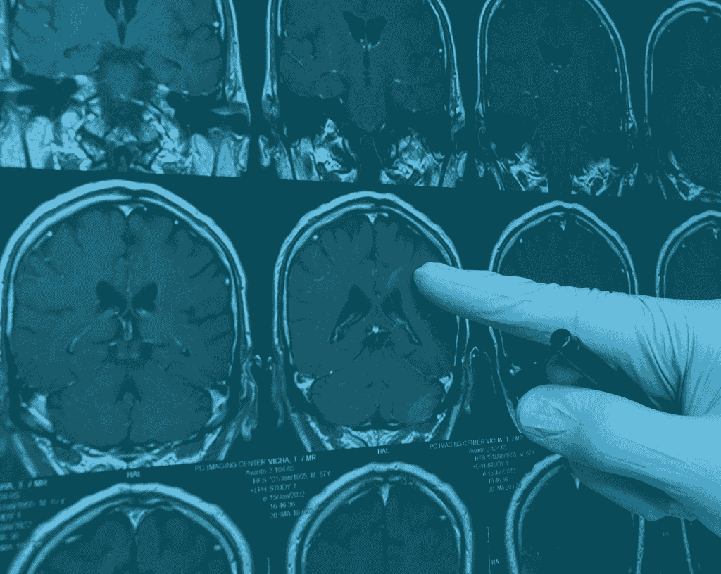 Trivent Neurologist Identifies Deviations from Standard of Care in Cerebral Venous Thrombosis Case