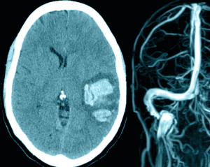 Trivent Neurologist Identifies Deviations from Standard of Care in Cerebral Venous Thrombosis Case