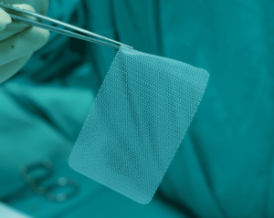 Unveiling Trivent’s Hernia Mesh Case Handling Strategy