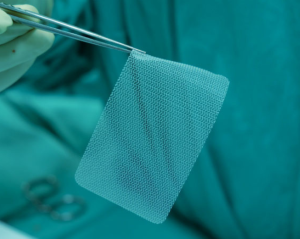 Unveiling Trivent’s Hernia Mesh Case Handling Strategy