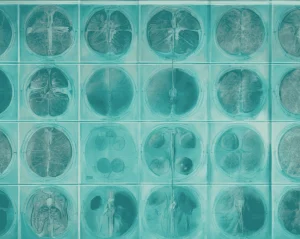 How to Prepare a Medical Chronology for Legal Cases