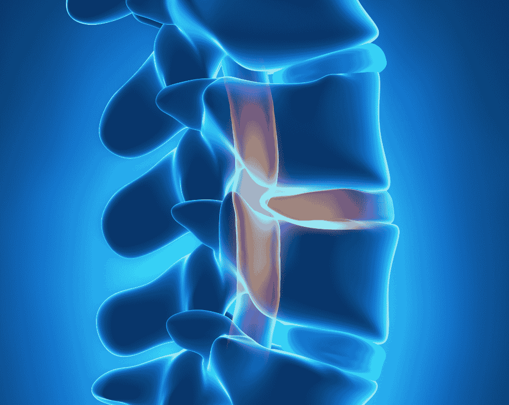 Did this Spinal Stenosis Surgery Cause Damage to the Patient?