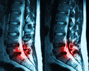 Did this Spinal Stenosis Surgery Cause Damage to the Patient?