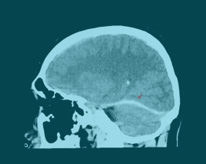 How Can Medical Chronologies Help Map PTSD Claims in Burn Injury Cases?      